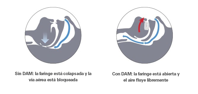 Gráfico del efecto de llevar o no una Narvall CC 