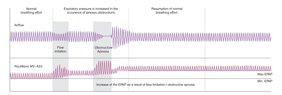 asv-asvauto-mode-aircurve10cs-pacewave-resmed